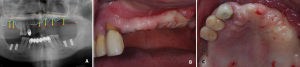 Extraction of teeth and implant installation at the lower jaw