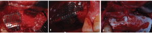 Process Maxillary sinus lift and GBR
