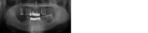 X-ray Panoramic radiograph at initial examination