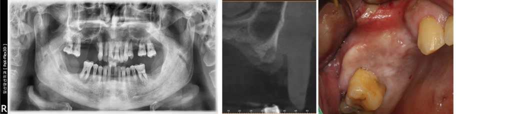 Pre-operative-radiograph-and-Intra-oral-view - Hiossen Implant Canada