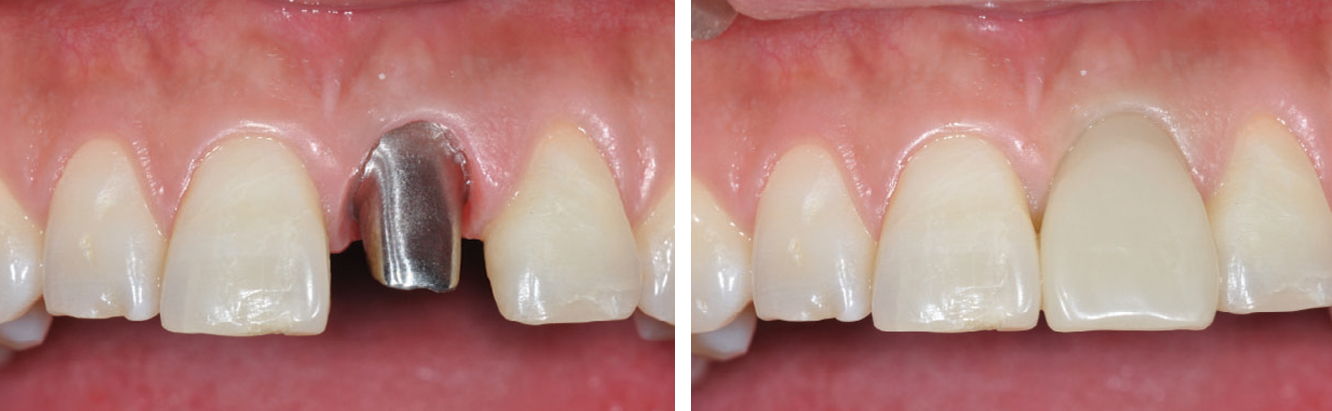 Abutment connection and a new provisional 