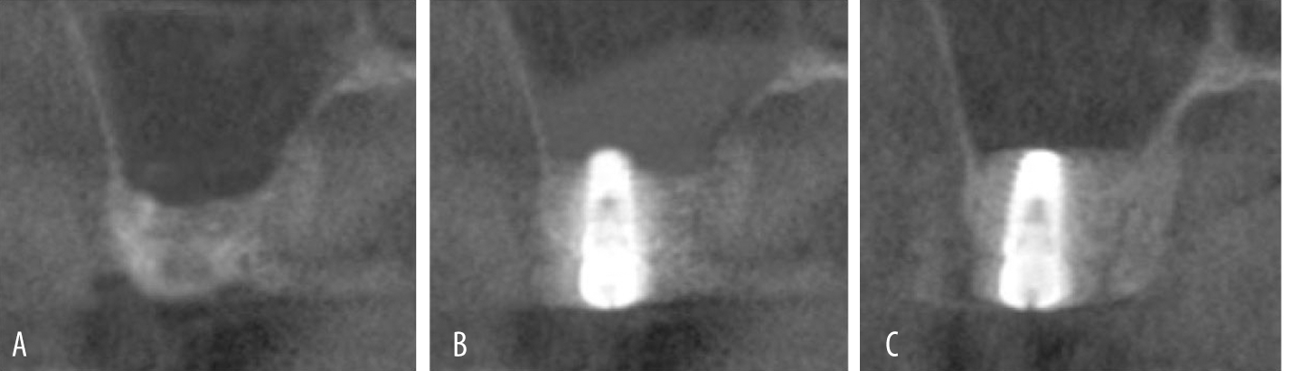Staged CBCT image (coronal view)